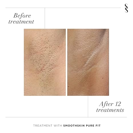 SmoothSkin Pure FIT Intelligent Ultrafast IPL Permanent Hair Reduction for Women & Men – Body & Face â€“ FDA Cleared