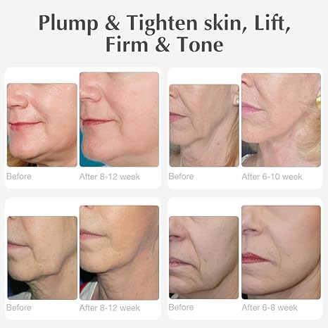 RF Beauty Device | Home RF Lifting | Wrinkle Removal | Anti Aging | Skin Care – Increase Collagen & Absorption – MLAY Professional Radio Frequency Skin Tightening for Face and Body – Salon Effects
