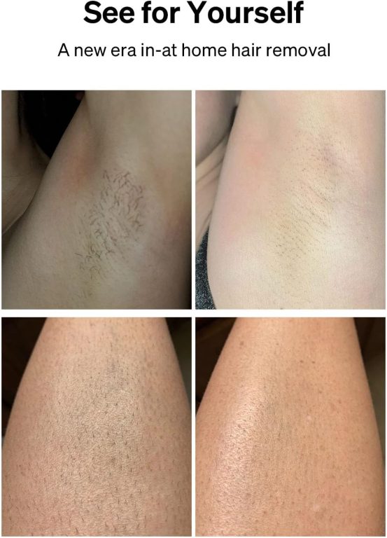 Ulike Laser Hair Removal for Women and Men, Air 3 IPL Hair Removal with Sapphire Ice-Cooling System for Nearly Painless & Long-Lasting Result, Flat-Head Window for Body & Face at-Home Use