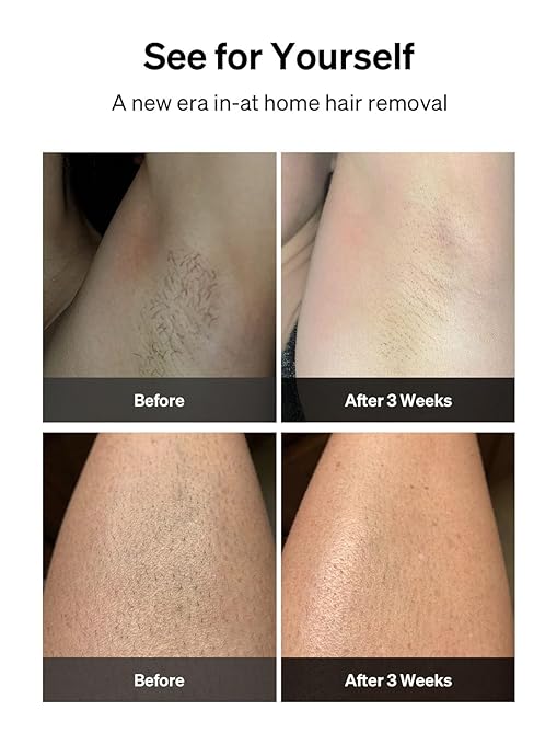 Ulike Laser Hair Removal for Women and Men, Air 3 IPL Hair Removal with Sapphire Ice-Cooling System for Painless & Long-Lasting Result, Flat-Head Design for Body & Face Treatment at-Home, Pink